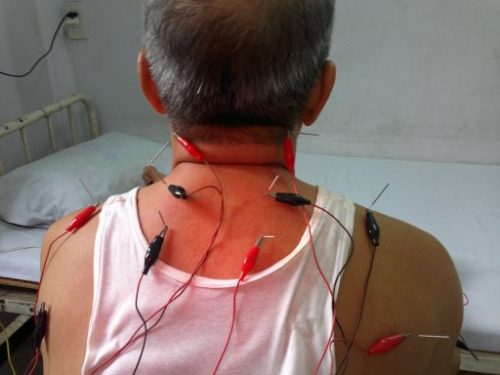phương pháp điện châm 